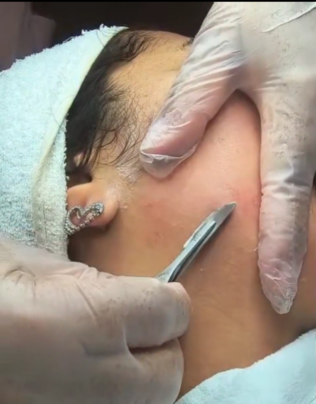 Dermaplaning