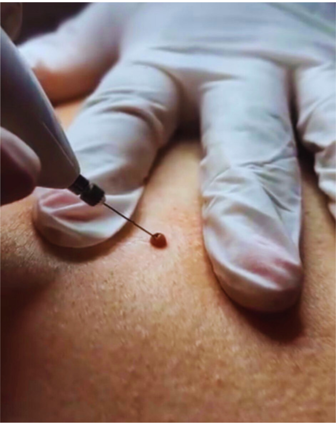 Remoção de Verrugas